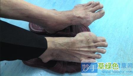 尿酸高有哪些症状要注意什么 尿酸高有哪些症状