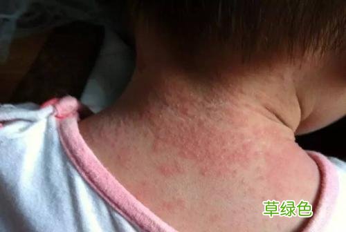 皮疹的症状和治疗 皮疹怎么治疗