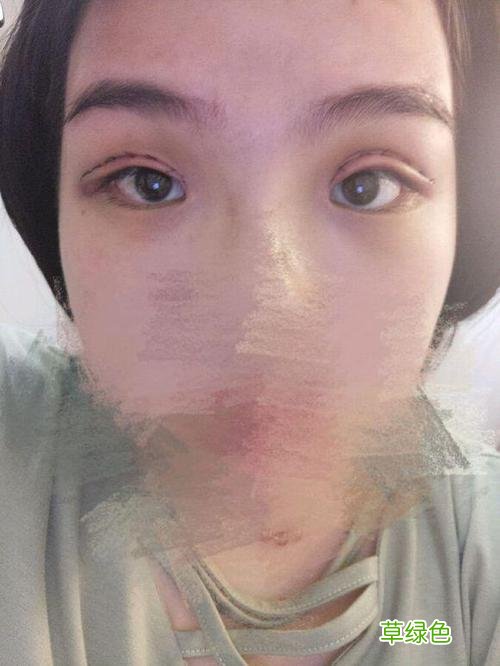 上眼皮吸脂手术 上眼皮抽脂手术