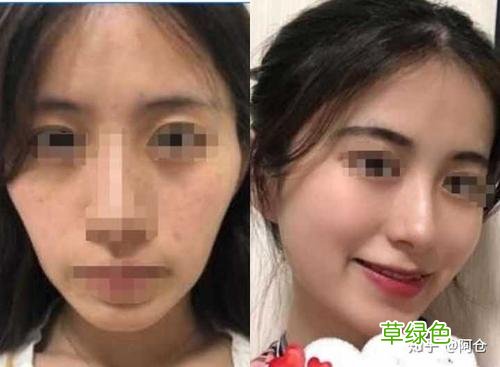 皮肤下垂有什么办法提升 皮肤下垂怎么办