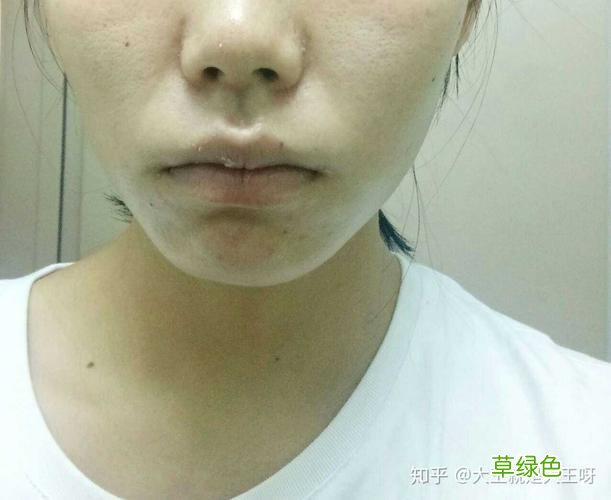 面部脂溢性皮炎可以自愈吗 面部脂溢性皮炎