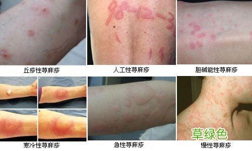 人工荨麻疹最佳治疗方法 人工荨麻疹症状