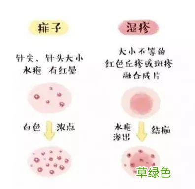 过敏性慢性湿疹的治疗方法 慢性湿疹治疗方法