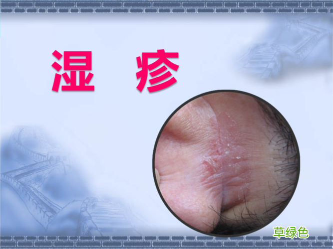 过敏性慢性湿疹的治疗方法 慢性湿疹治疗方法