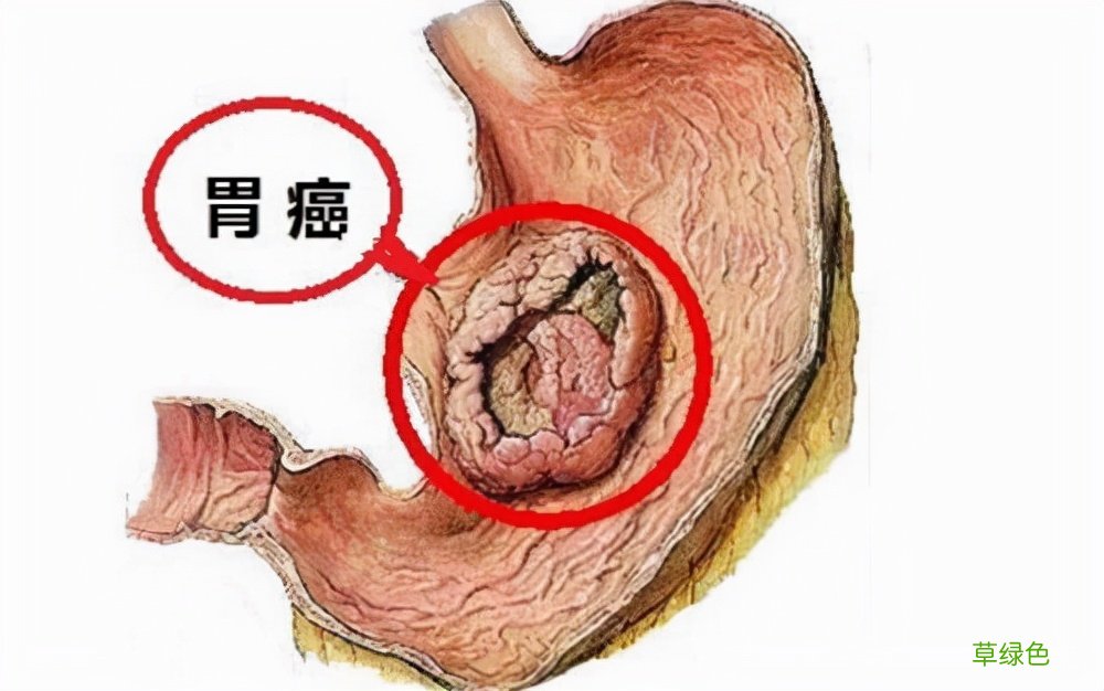 幽门螺杆菌阳性口臭去医院看什么科 幽门螺杆菌阳性口臭