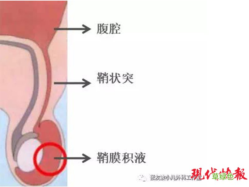 睾丸一边大一边小怎么办 睾丸一边大一边小