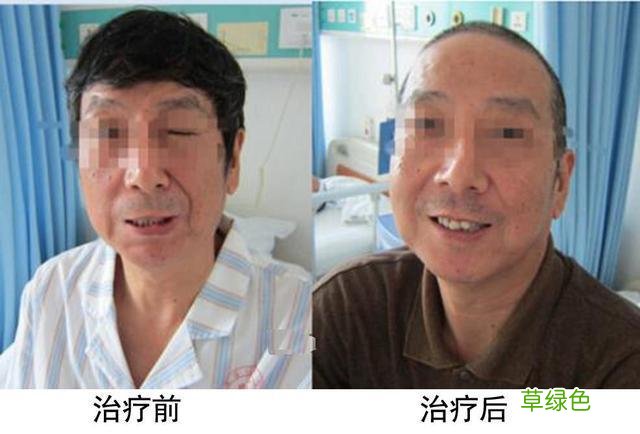 面部肌肉痉挛怎么办 面部痉挛怎么办