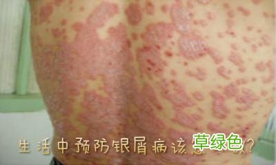 牛皮皮癣传染么 牛皮癣的原因