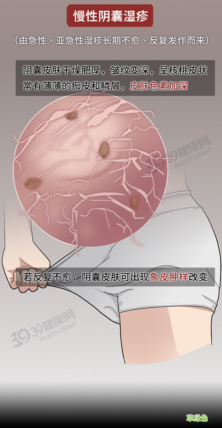 男性阴囊湿疹会不会传染 阴囊湿疹传染吗