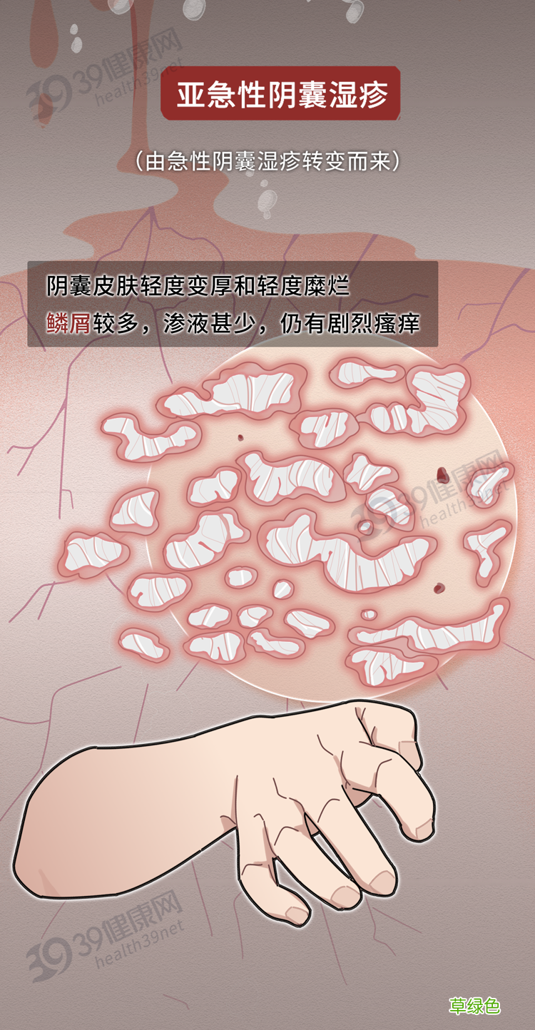 男性阴囊湿疹会不会传染 阴囊湿疹传染吗