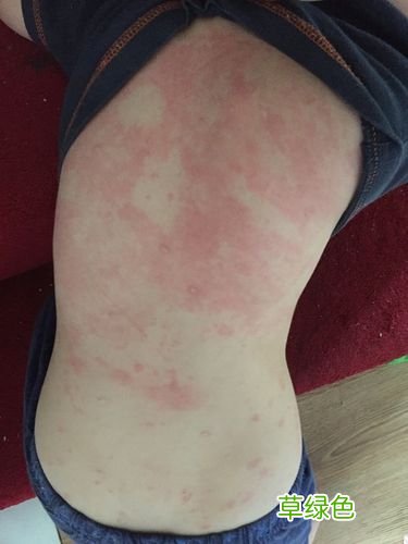 身上老是很痒怎么回事 身上很痒怎么办