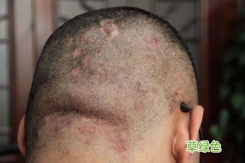 皮炎怎么治能除根 皮囊炎怎么治