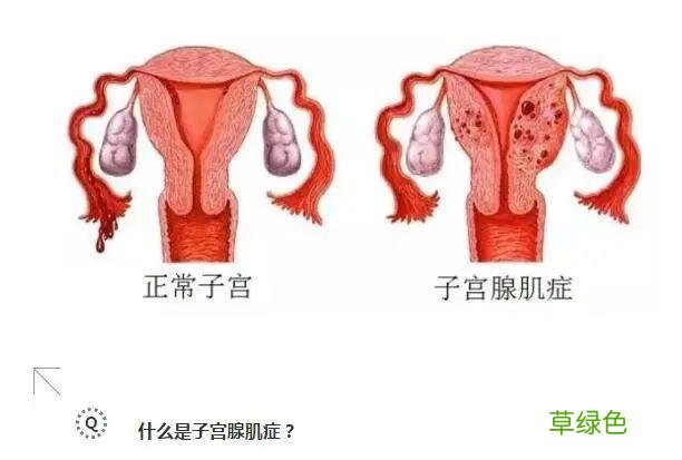 什么是妇科腺肌症 什么是腺肌症