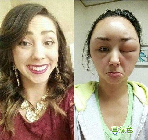 脸部浮肿是什么原因 该怎么办 面部浮肿的原因