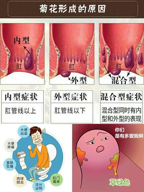 女性痔疮治疗方法视频 女性痔疮治疗方法