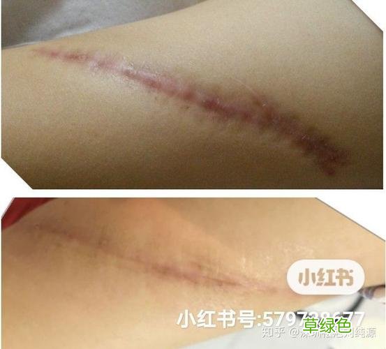 手术后留下的疤痕用什么药修复好 祛除手术疤痕