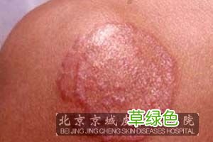 股癣能彻底治好吗 股癣最佳治疗方法