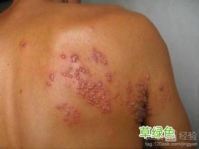 疱疹怎么治疗最快 疱疹怎么治疗