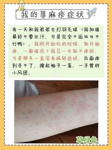 胆碱能行荨麻疹吃枸地氯雷他定片,还是氯雷他定片好 胆碱能行荨麻疹