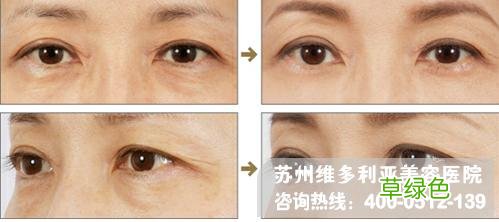 去眼袋用什么 去眼袋哪家好