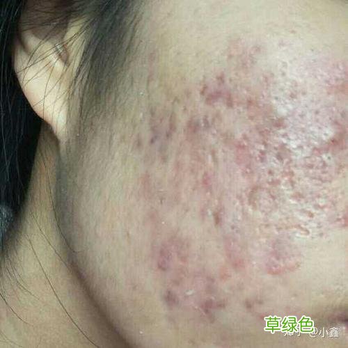 痘印疤痕怎么去除 祛除痘印的方法