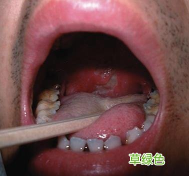 中医治疗白塞成功案例 白塞病如何治疗