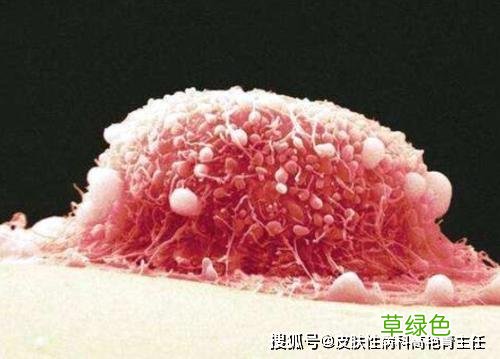 女性湿锐疣尖怎么样辨别 女性尖锐湿疣初期