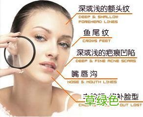 鱼尾纹可以去除吗 如何消除鱼尾纹