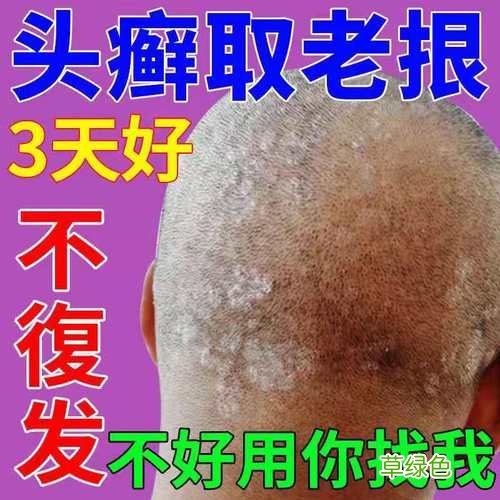 治皮肤癣的药膏 牛皮癣特效药
