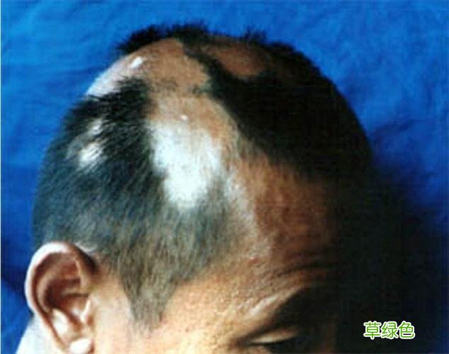 男人头顶秃是什么原因 男人秃头原因