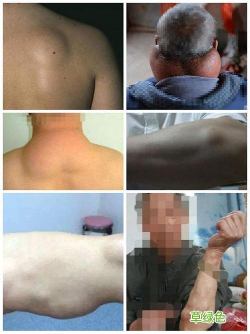 脸部皮下脂肪瘤图片 皮下脂肪瘤图片