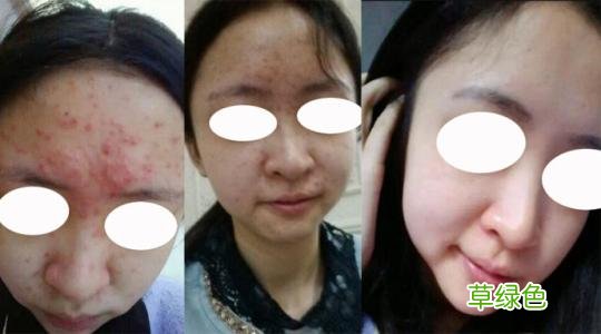 怎样去痘印安全有效 如何去痘印最有效