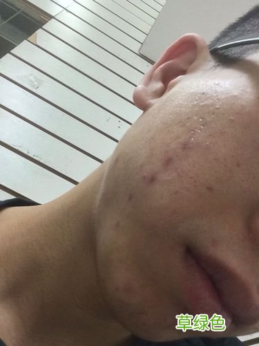 男性毛孔粗大怎么处理 男性毛孔粗大
