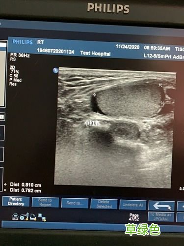 婴儿鞘膜积液症状 鞘膜积液症状