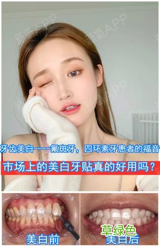 美白牙贴好吗 美白贴