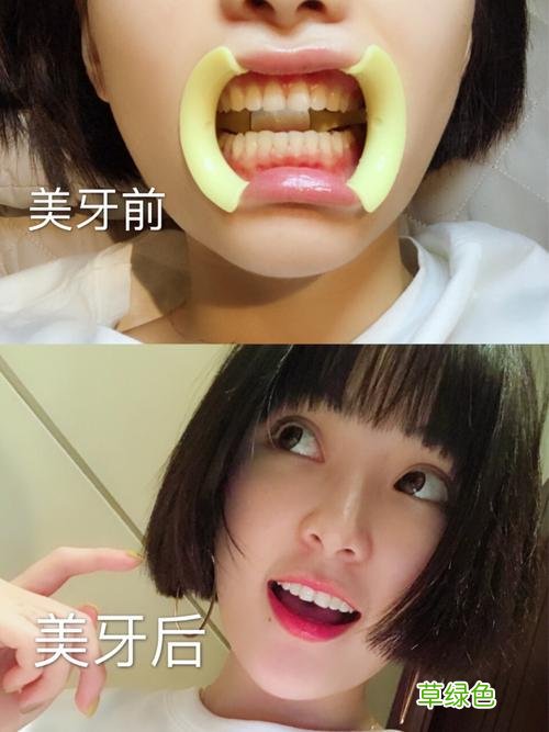 美白牙贴好吗 美白贴
