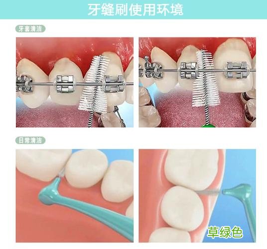 牙缝大修复多少费用 牙缝刷