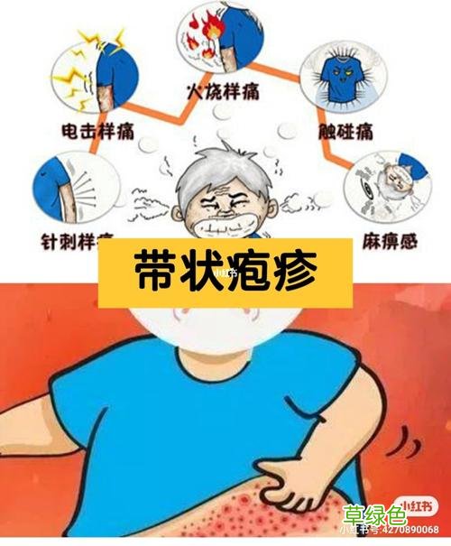 带状疱疹后遗神经痛发作频繁 带状疱疹会频繁发作吗