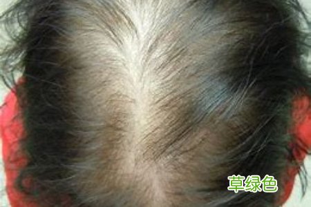 深蹲是否会脱发-小面积脱发植发